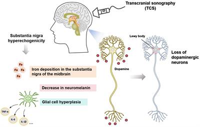 Advancements in understanding substantia nigra hyperechogenicity via transcranial sonography in Parkinson’s disease and its clinical implications